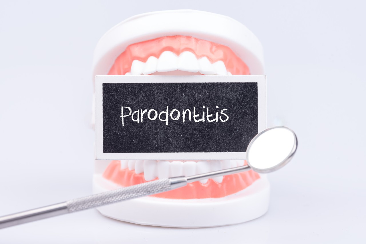 parodontitis